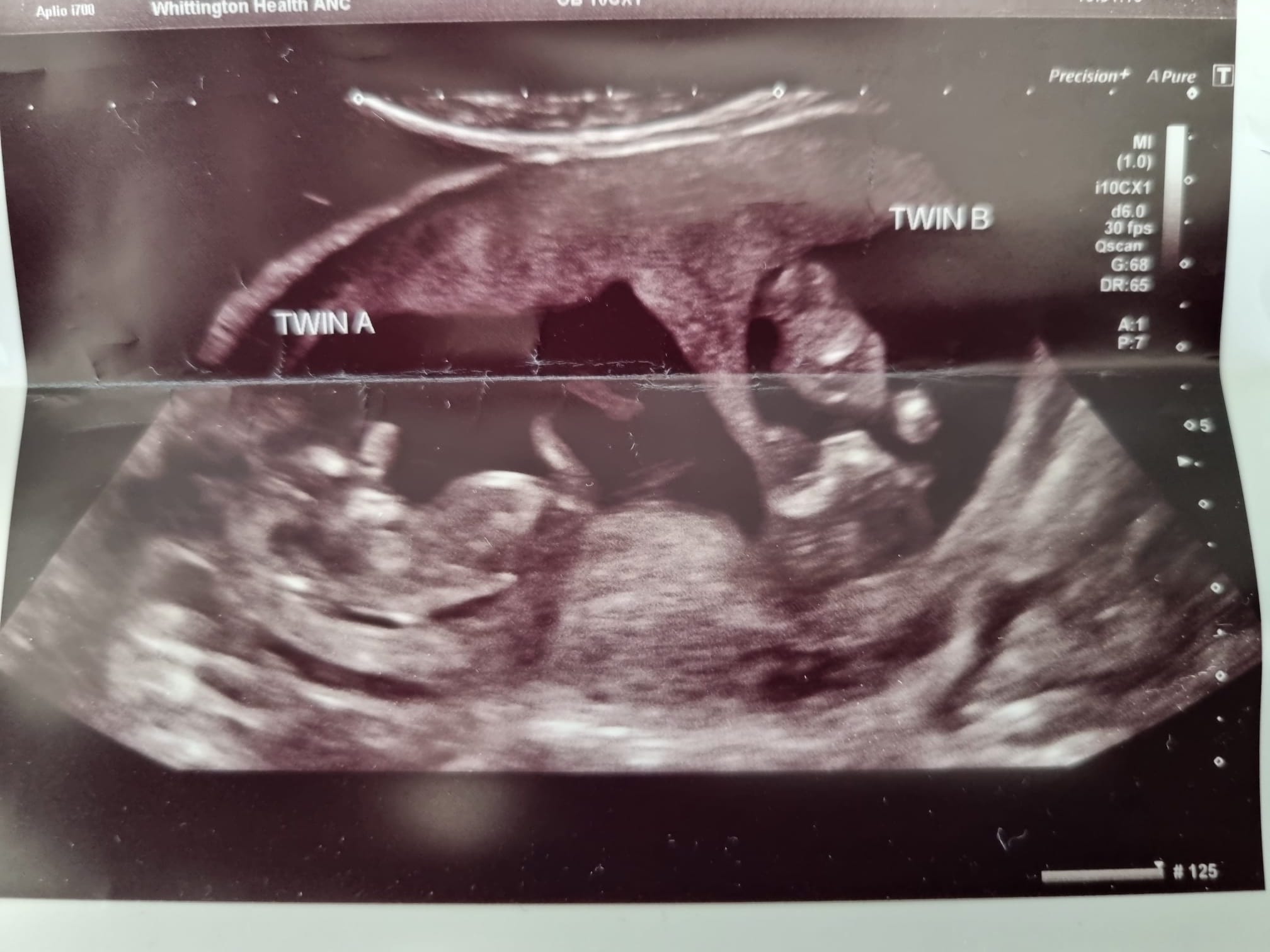 I’m Pregnant. With Twins.