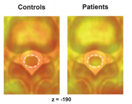 Neuroinflammation in radicular pain with Daniel Albrecht
