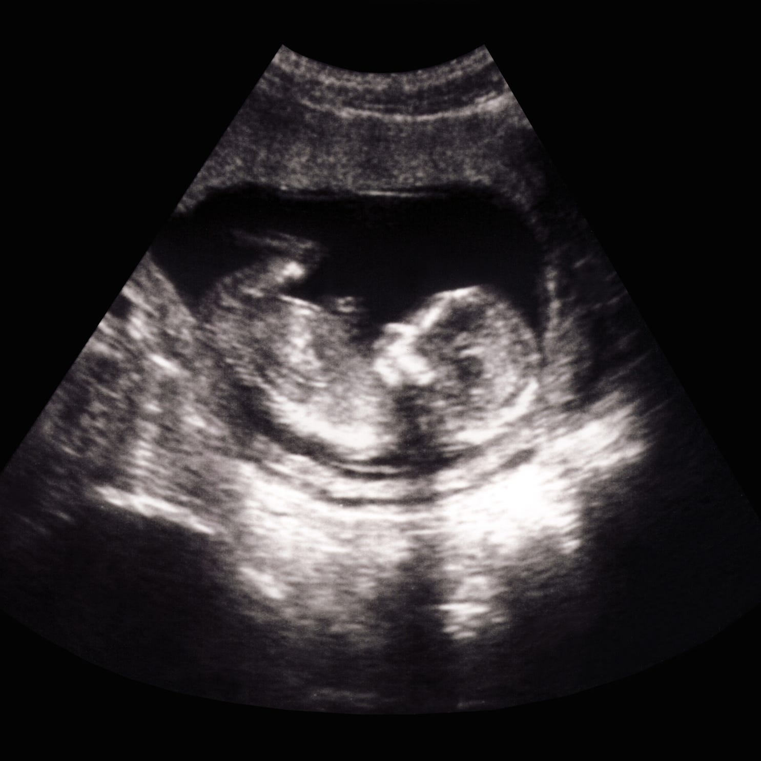 Screening for Fetal Chromosomal Abnormalities