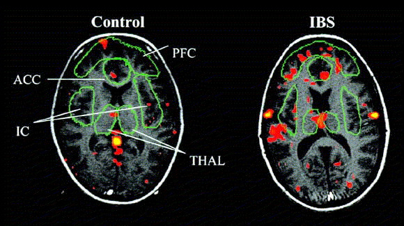 Heather\'s IBS Newsletter - Help for Irritable Bowel Syndrome.