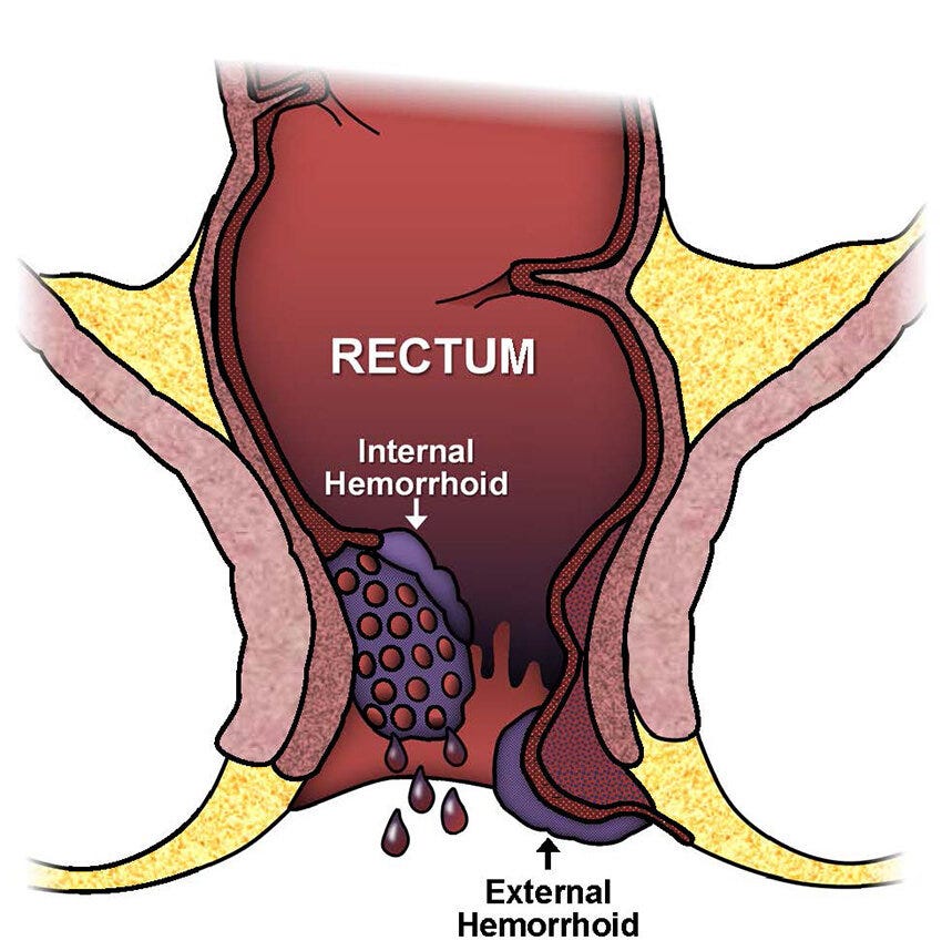 Rectal bleeding: how to approach symptoms that may or may not be related to having MS episode artwork