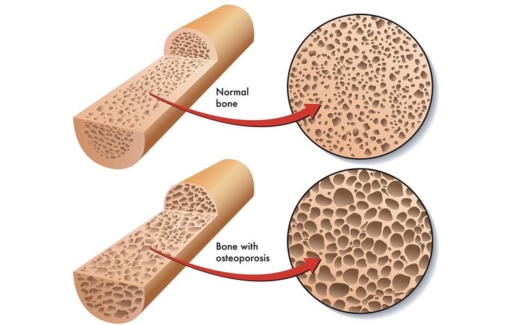 Sodium Restriction Causes Bone Loss (Osteoporosis) Sodium Restriction Causes Bone Loss (Osteoporosis)