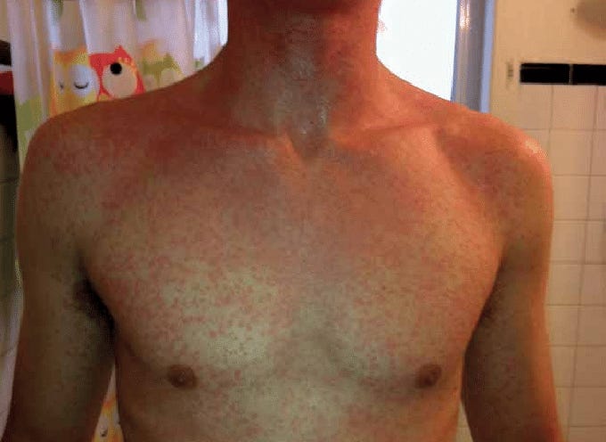 Heat Rash Hell: A 35-Year Struggle and the Bee Pollen That Saved Me