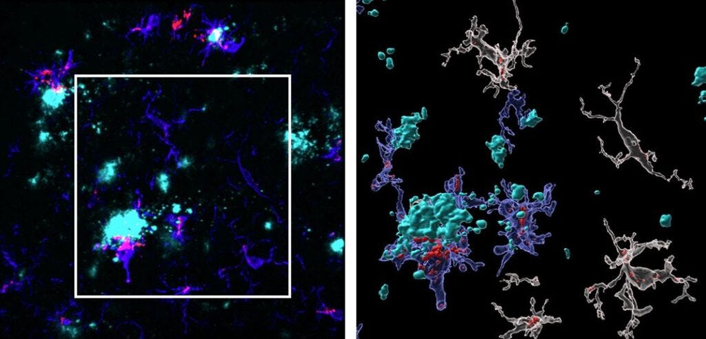Tomas R. Guilarte, Florida International University – Can We Detect Alzheimer’s Disease Decades Before Symptoms Start?
