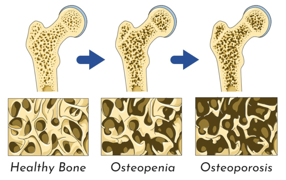 Osteopenia and Osteoporosis episode artwork