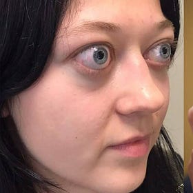 Stanford Drops Bombshell: COVID Jabs Tied to Surge in Thyroid Eye Disease That Can Cause Blindness