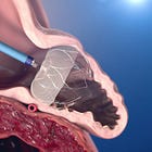 Oclusão percutânea do apêndice atrial esquerdo 