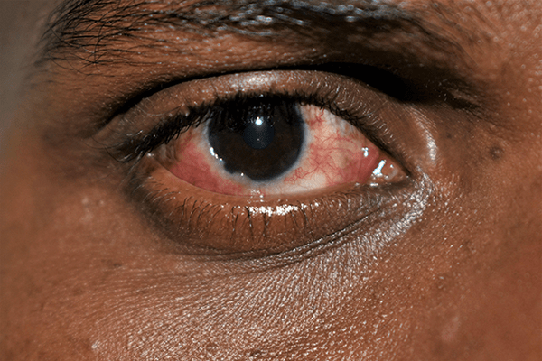 Conjunctivitis (Pinkeye) - Doctors in Service Clinic