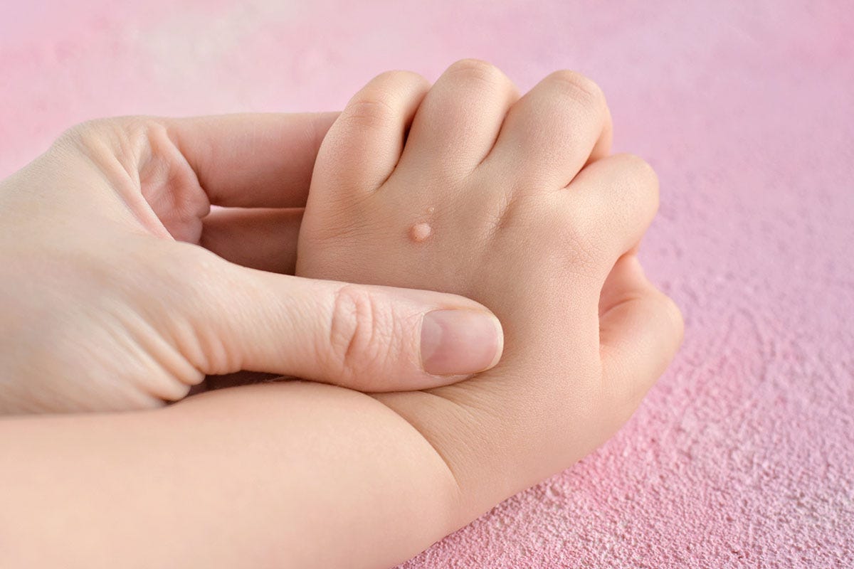 Treating Pediatric Warts and Molluscum Treating Pediatric Warts and Molluscum
