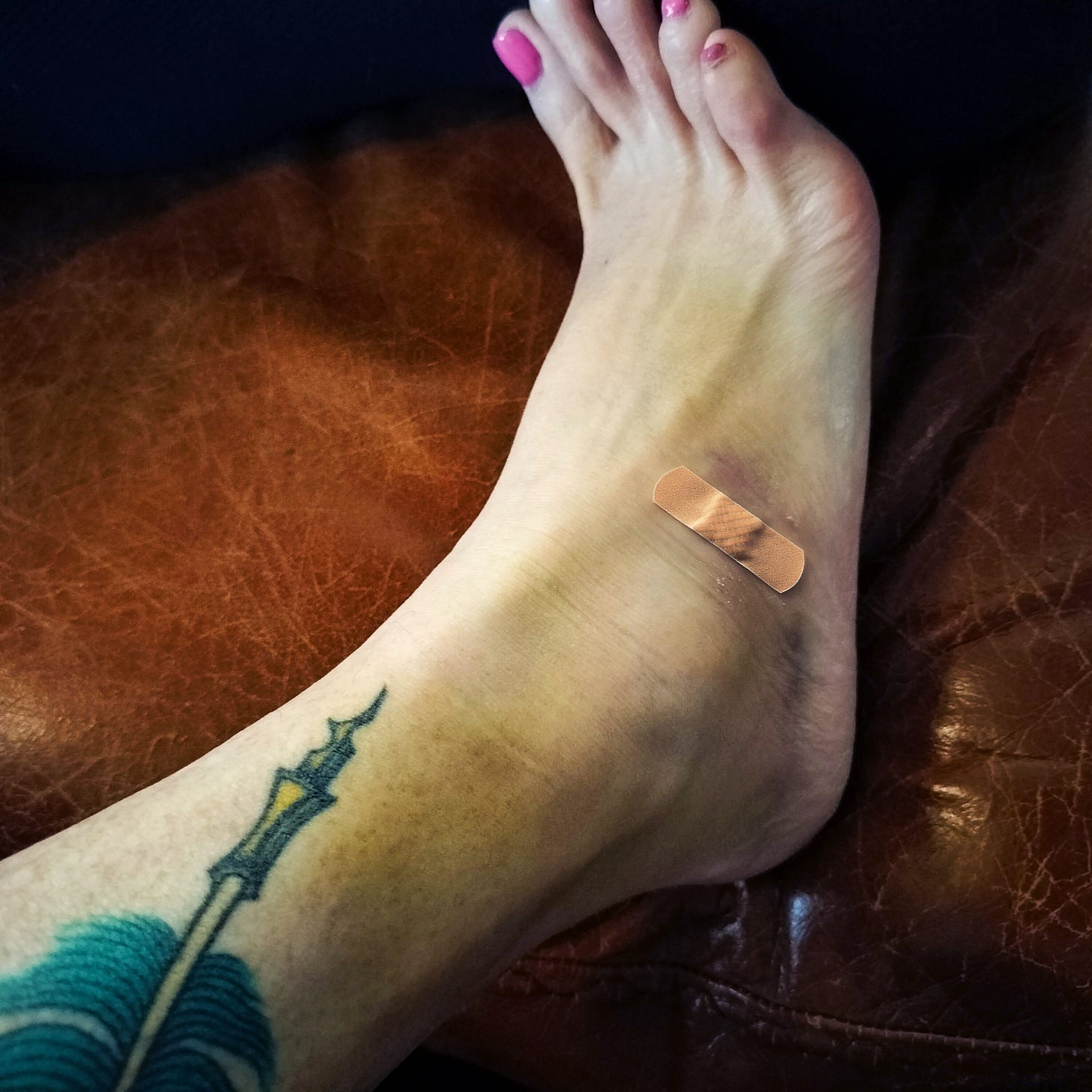 A sprained ankle, swollen and bruised with a small bandage