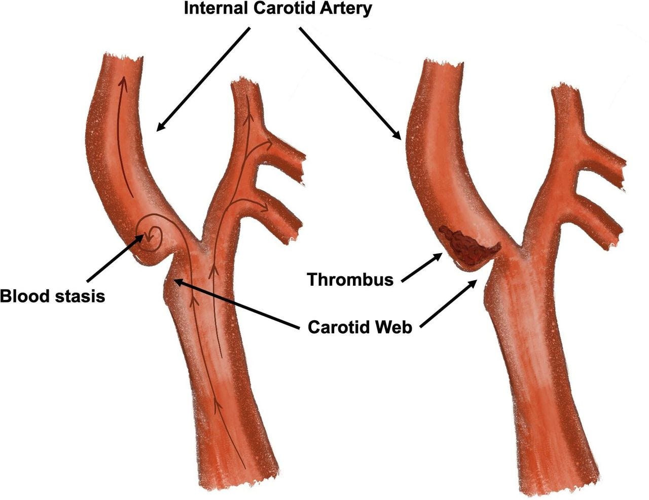 Carotid web causing recurrent ischaemic stroke | Practical Neurology