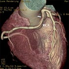 Origem anômala de coronárias
