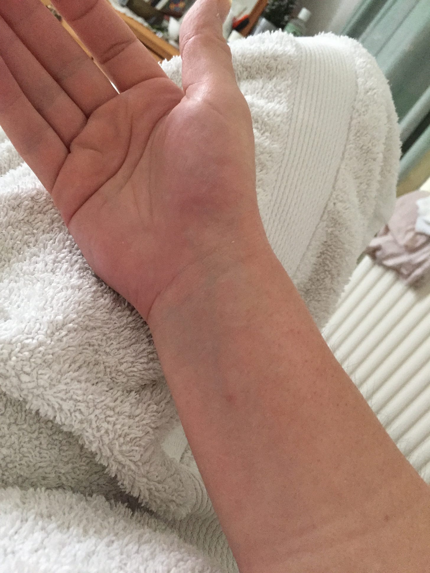 a right hand and wrist on a towel, looks an odd shape and colour.