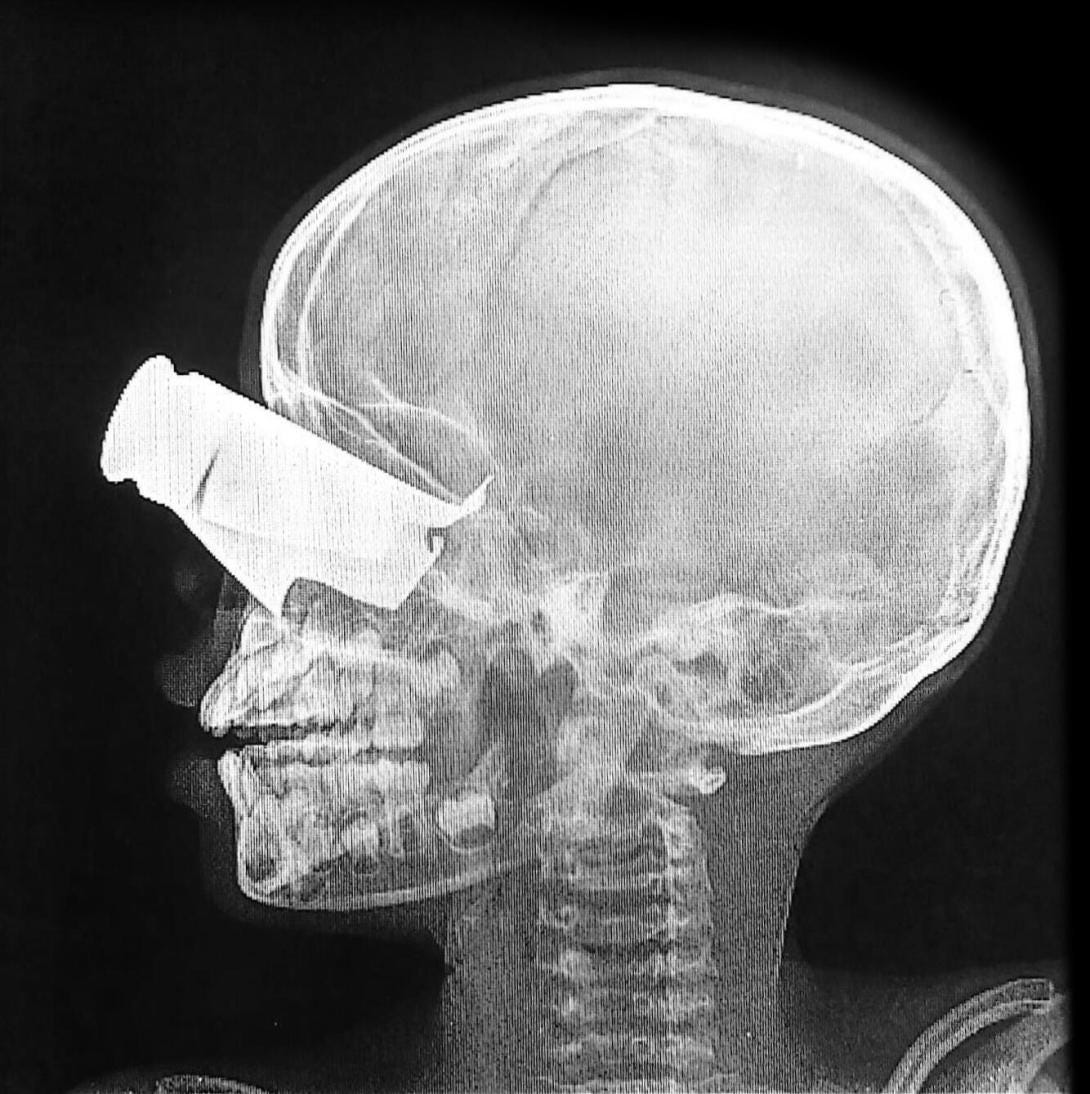 Radiografía de un niño con herida de metralla. Radiografía de un niño con herida de metralla