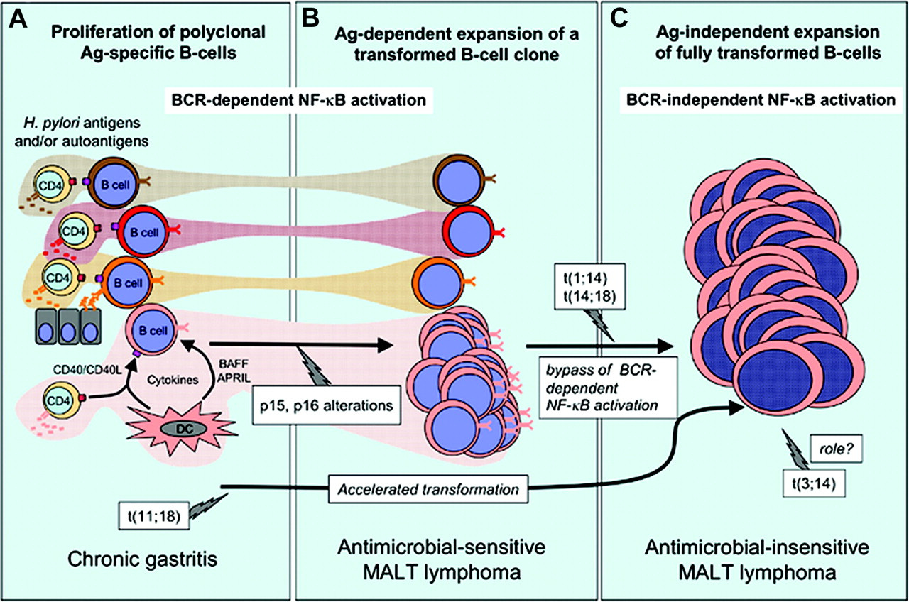 H pylori and gastric MALT lymphomagenesis paradigm for infection-associated indirect lymphoid transformation. (A) Persisting antigens (Ag's) elicit a polyclonal B-cell response. Costimulation is provided by cytokines and members of the tumor necrosis factor superfamily (CD40-CD40L in T-cell–dependent responses and B-cell activating factor [BAFF]/B-lymphocyte stimulator [BLyS] or a proliferation-inducing ligand [APRIL] produced by dendritic cells in T-cell–independent responses). In the case of H pylori, T cells specific for H pylori epitopes provide help to B cells that recognize cross-reactive autoantigens present in the gastric mucosa such as fucosylated sialyl–Lewis X through CD40-CD40L costimulation. (B) Occurrence of genetic events such as p15 and p16 hypermethylation provide a selective advantage leading to the outgrowth of an antigen-responsive clone. Antigen dependence reflects the requirement for BCR signals such as NF-κB activation (see also Figure 5). (C) Progression toward antigen-independent (therefore antimicrobial-insensitive) MALT lymphoma is associated with the occurrence of additional genetic events. Chromosomal translocations involving MALT1 and Bcl-10 lead to a constitutive activation of NF-κB, bypassing the requirement for BCR-dependent signals (Figure 5). The t(11;18) translocation occurs early during B-cell proliferation and accelerates the transformation process in an antigen-independent fashion. The t(1;14) and t(14;18) translocations also lead to BCR-dependent NF-κB activation, but occur later after an antigen-dependent phase and can be associated with additional cytogenetic abnormalities. The t(3;14) translocation produces an IgH-FoxP1 transcript in 10% of MALT lymphomas that do not harbor other translocations involving the MALT1/Bcl-10 pathway. The precise role of t(3;14) is not known. P53 mutation is associated with transformation to high-grade lymphoma.