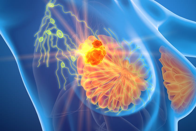 Breast cancer – USZ Breast cancer – USZ