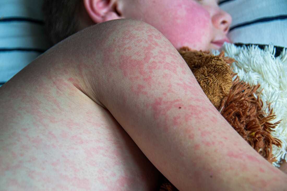 A child covered in a red rash.