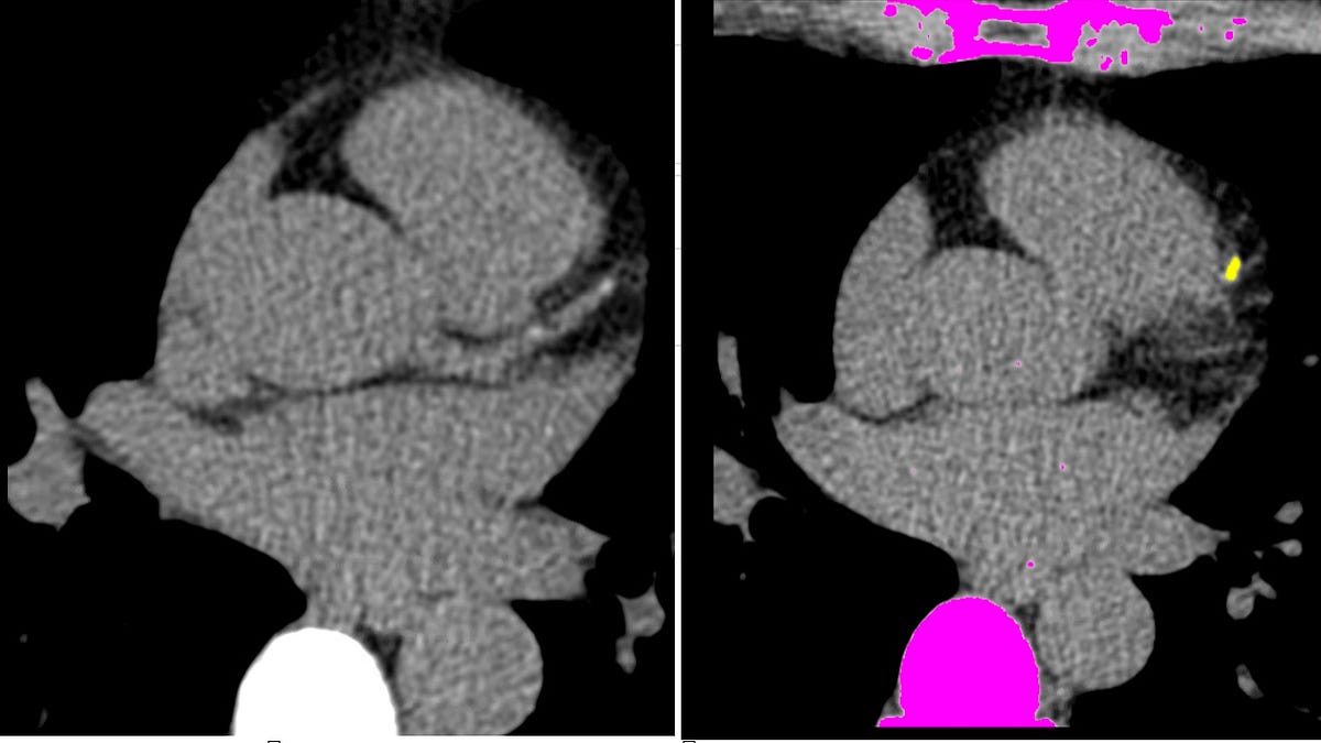 Normal Heart Scan The Skeptical Cardiologist's Guide To The Coronary Artery Calcium Scan