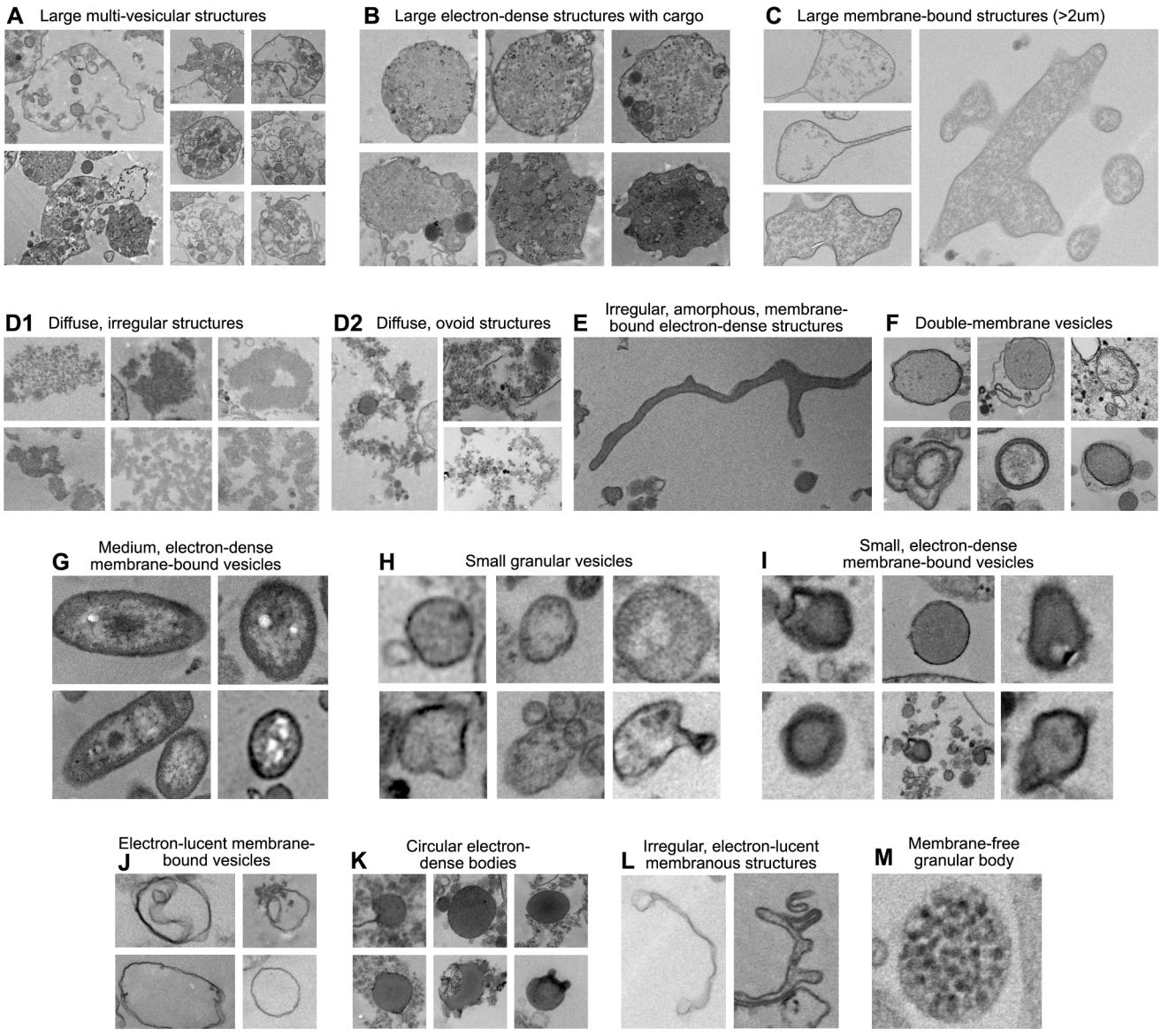 Categorization of particle types in human plasma, serum, and saliva. (A) Large membrane-bound, multi-vesicular structures; (B) Large electron-dense structures, with occasional vesicular cargo; (C) Large membrane-bound, electron-lucent, granular structures; (D1) Diffuse, irregular structures; (D2) Diffuse, ovoid structures; (E) Irregular, amorphous, membrane-bound electron-dense structures; (F) Double-membrane vesicles; (G) Medium membrane-bound electron-dense vesicles complex ovoid structures with compartmentalized granular material, and electron-dense external membrane; (H) Small granular vesicles; (I) Small membrane-bound electron-dense vesicles; (J) Small membrane-bound electron-lucent vesicles; (K) Small circular, electrondense amorphous bodies; (L) Small membranous irregular structures; (M) Small circular membrane-free granular body.