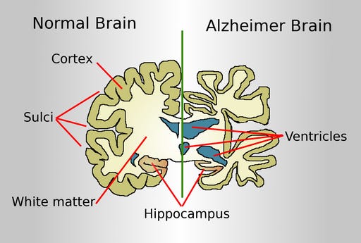What Happens to Your Brain When You Stay Up All Night?