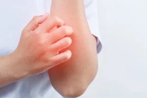 Person scratching their arm