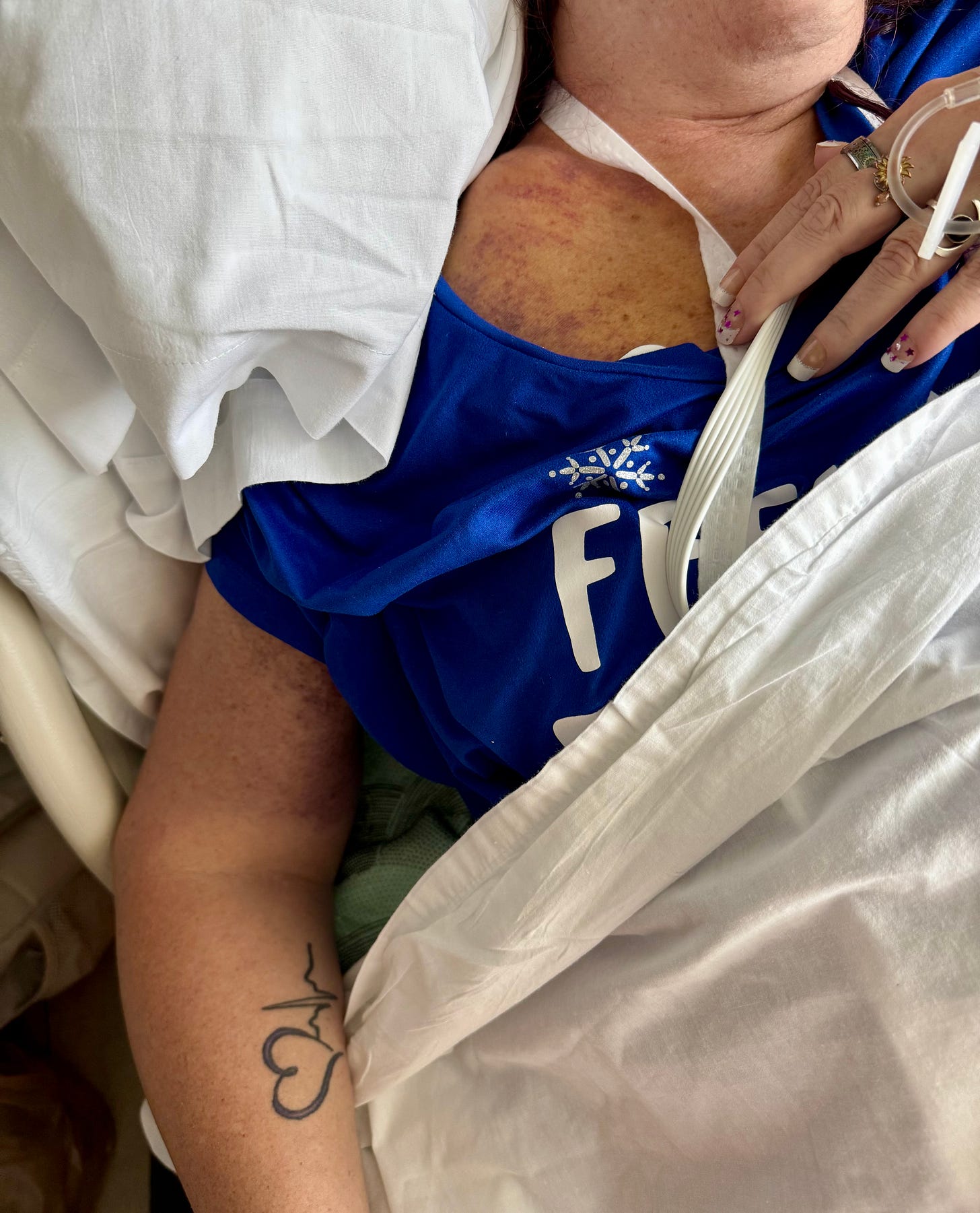 A woman lying in a hospital bed, partially covered with a white sheet. She is wearing a blue shirt with white text and a snowflake design. Her collarbone and shoulder area are visibly bruised, with a large purple discoloration. Medical monitoring straps and wires are attached to her upper body and fingers. Her hand rests on her chest, showing painted nails and several rings. A tattoo of a heart and heartbeat line is visible on her forearm.