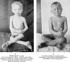 (L) Finsen's "light elves" (R) Auguste Rollier (C) young patient with Rickets treated with light therapy
