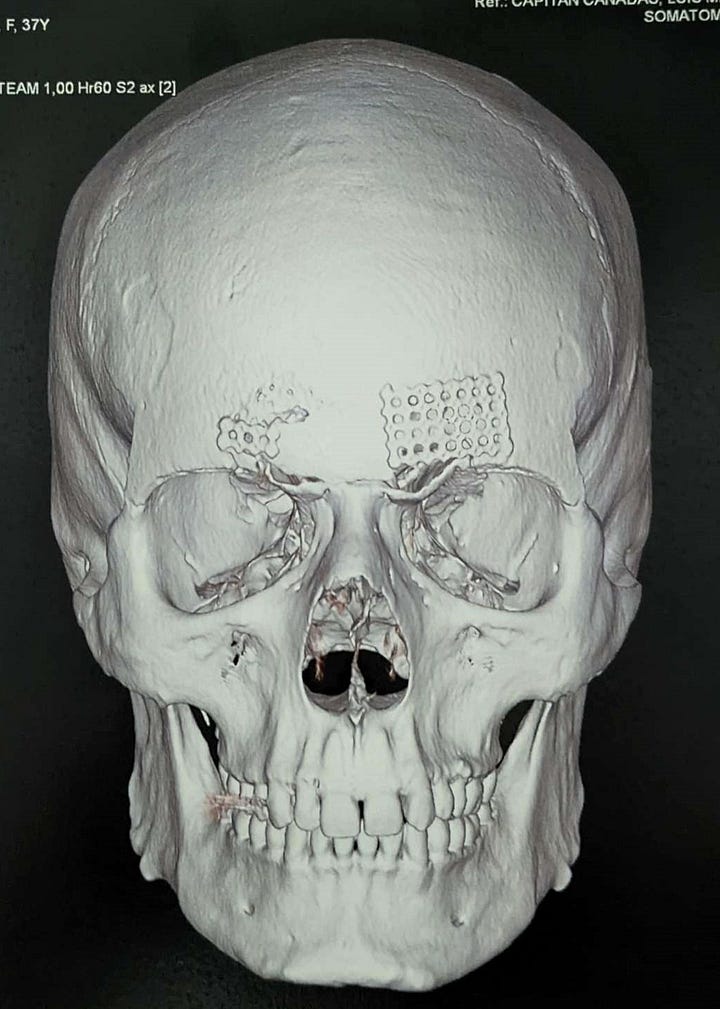 Two CT scans, in profile and portrait, of Doc Impossible's skull. Her brow ridge is completely gone, and the eye sockets are open and normal.