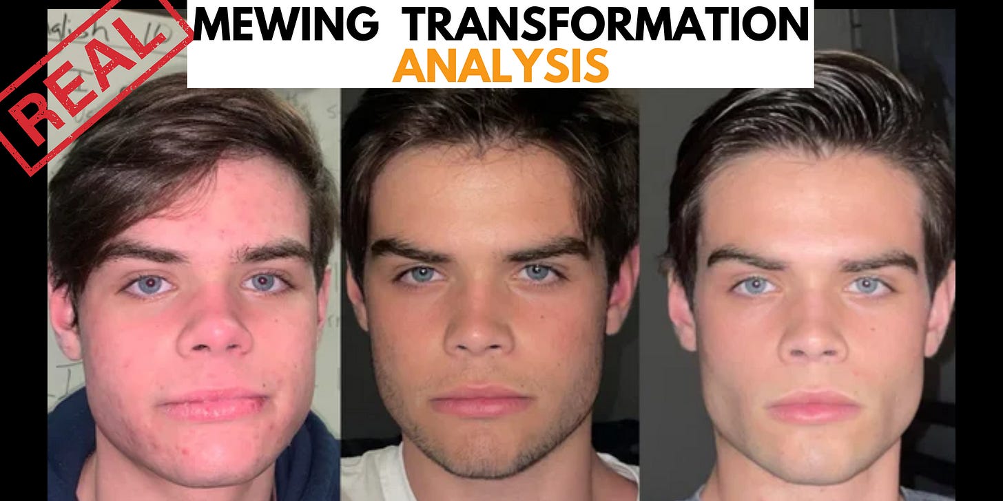 2-Year Mewing Transformation: Mewing Redefines Facial Structure | Mewinghub