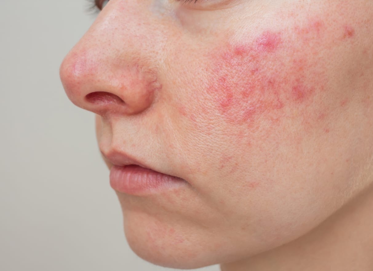 Rosacea > Fact Sheets > Yale Medicine