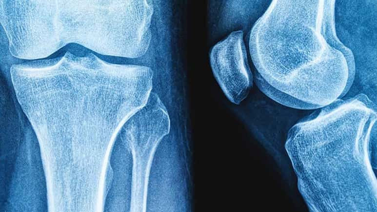 microplastics and bone health
