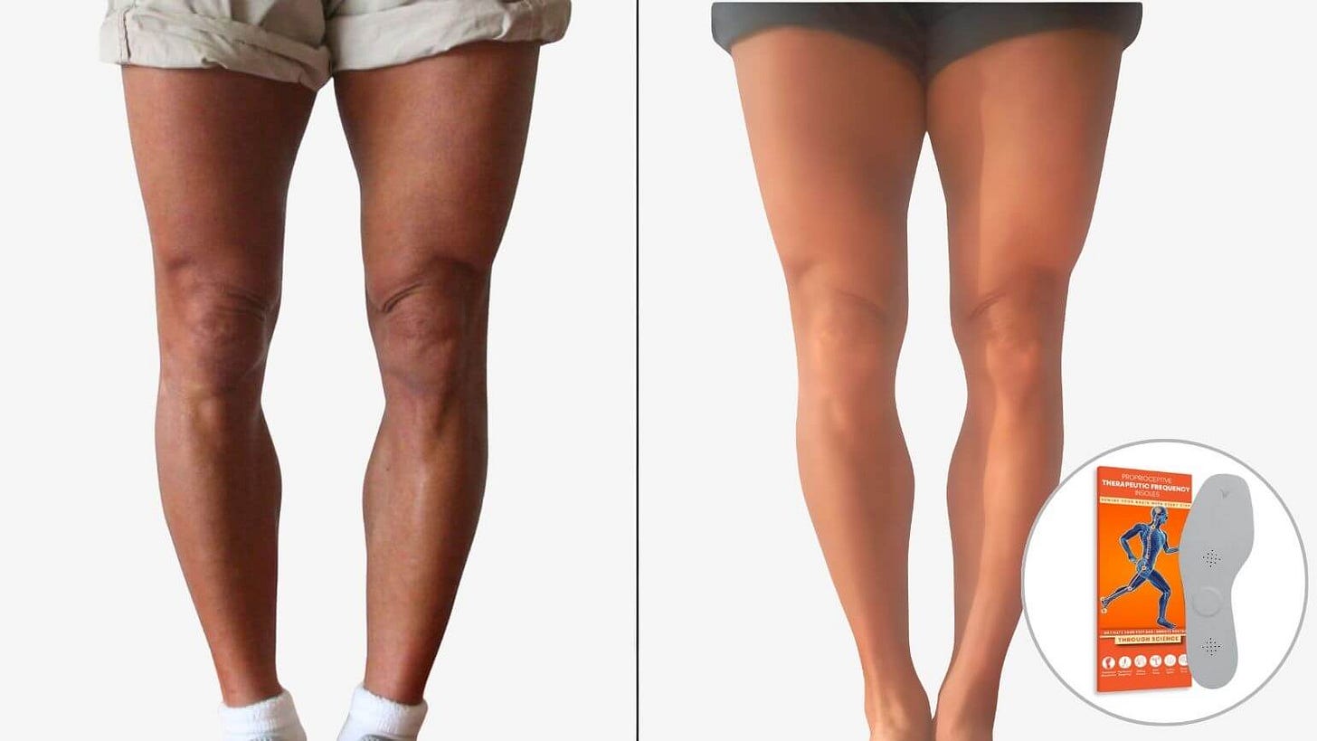 Bow legs correction without surgery using therapeutic insoles for improved leg alignment