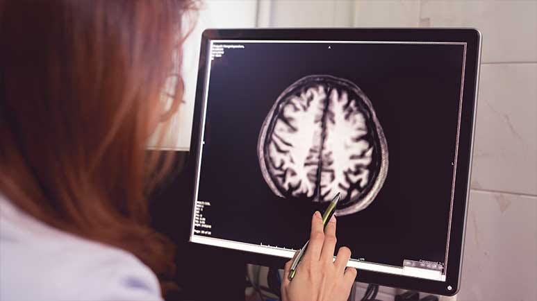 early warning signs parkinsons dementia