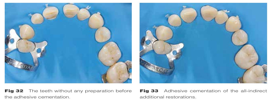 Post Indirect Kit Posterior indirect adhesive restorations: updated indications and the ...