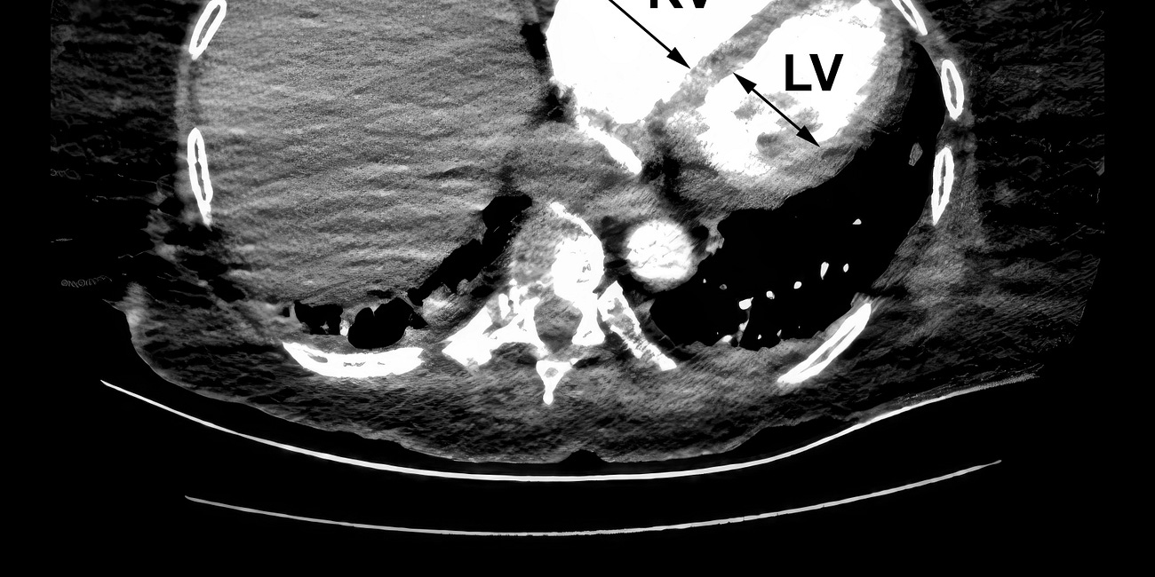 Thrombectomy vs. anticoagulation alone for intermediate-high risk PE (STORM-PE trial)