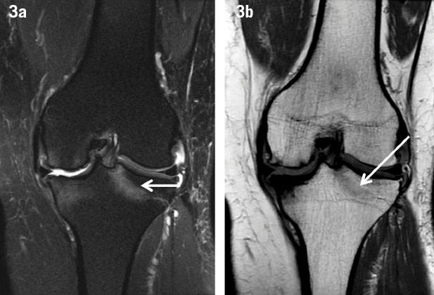 Aspetar Sports Medicine Journal - The role of imaging in tibia stress injury Aspetar Sports Medicine Journal - The role of imaging in tibia stress injury