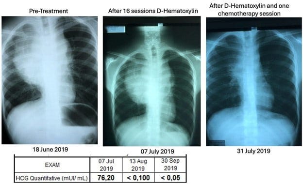 mediastinal seminoma
