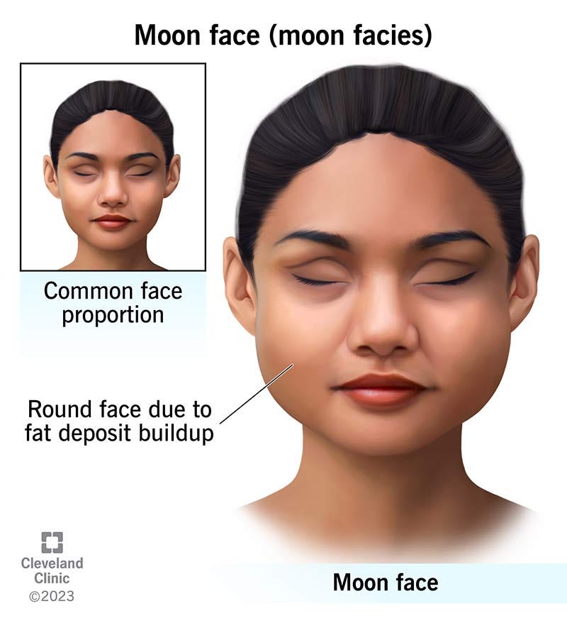 Moon Face: Causes & Treatment Moon Face: Causes & Treatment