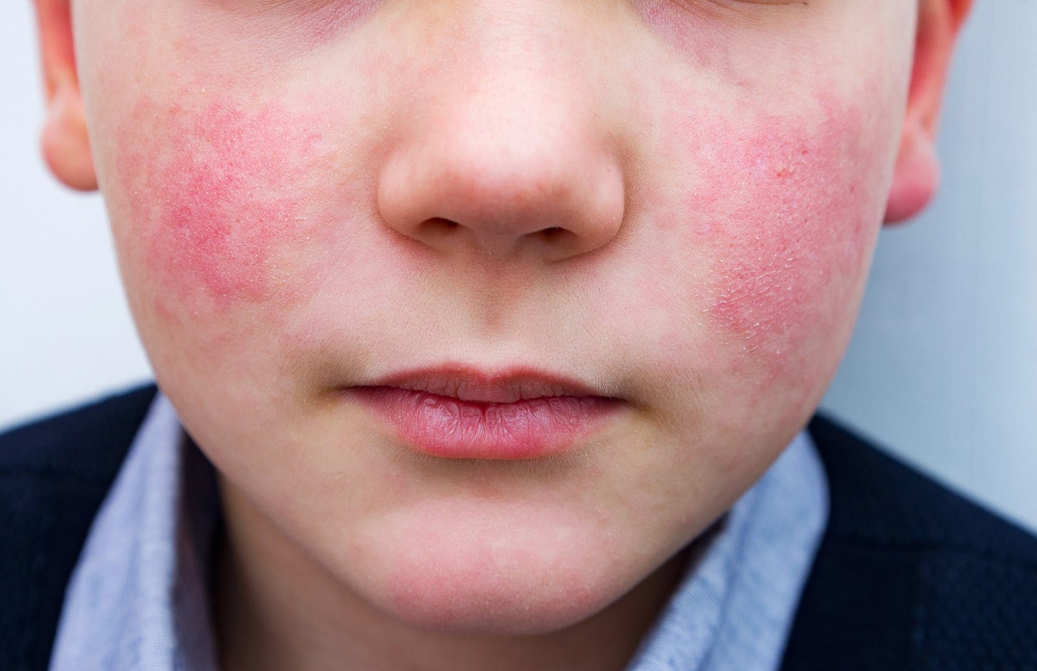 Image of parvovirus B19 "slapped cheek" rash Image of parvovirus B19 "slapped cheek" rash