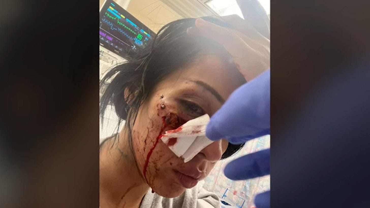 Woman shot in face with less-lethal round during downtown LA ICE protest files claim against Los Angeles police - ABC7 Los Angeles Woman shot in face with less-lethal round during downtown LA ICE protest files claim against Los Angeles police - ABC7 Los Angeles