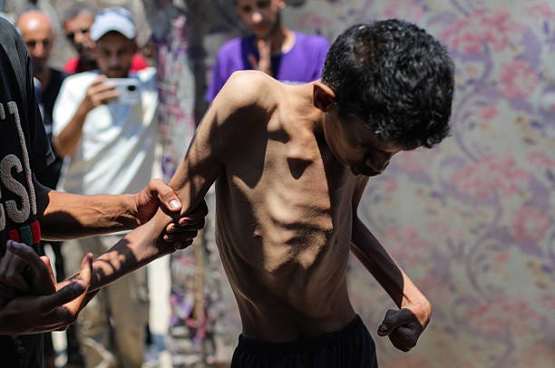Hamza Mishmish suffers from severe malnutrition and bone loss in the Nuseirat Refugee Camp in Deir al-Balah, Gaza amid worsening hunger in the...