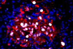 In this image, tdTomato cancer cells (red) are seen awakened by chemotherapy-induced inflammation, while Ki67 (white) marks proliferating cells. Credits:Image: Jingwei Zhang/Whitehead Institute