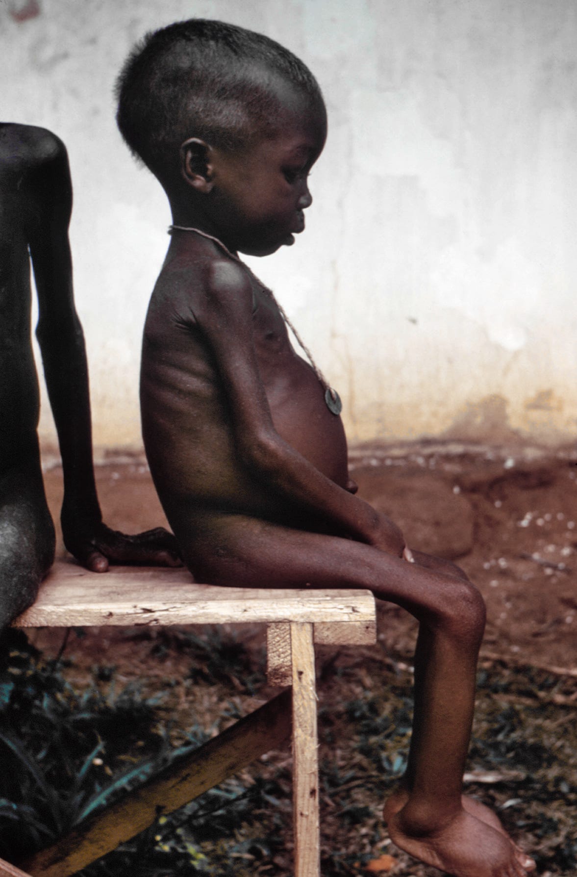A child suffering the effects of severe hunger and malnutrition as a result of the blockade. Pictures of the famine caused by Nigerian blockade garnered sympathy for the Biafrans worldwide. It was regarded in the Western press as the genocide of 2 million people, half of them children