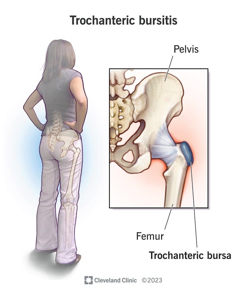 Hip pain is the most common trochanteric bursitis symptom.