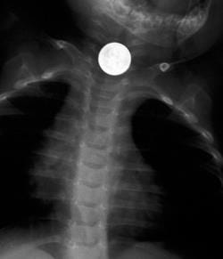 Child Choking Injuries