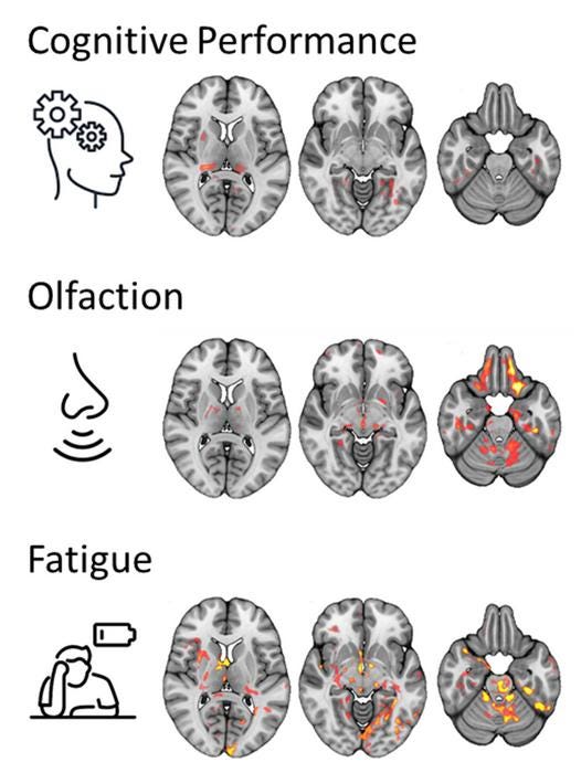 MRI Brain Changes in Long-COVID MRI Brain Changes in Long-COVID