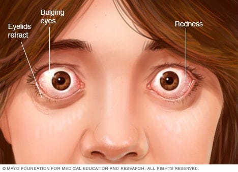 Eye complications associated with Graves' disease Eye complications associated with Graves' disease