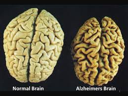 Is it dementia, memory loss, or Alzheimer's? - Iona