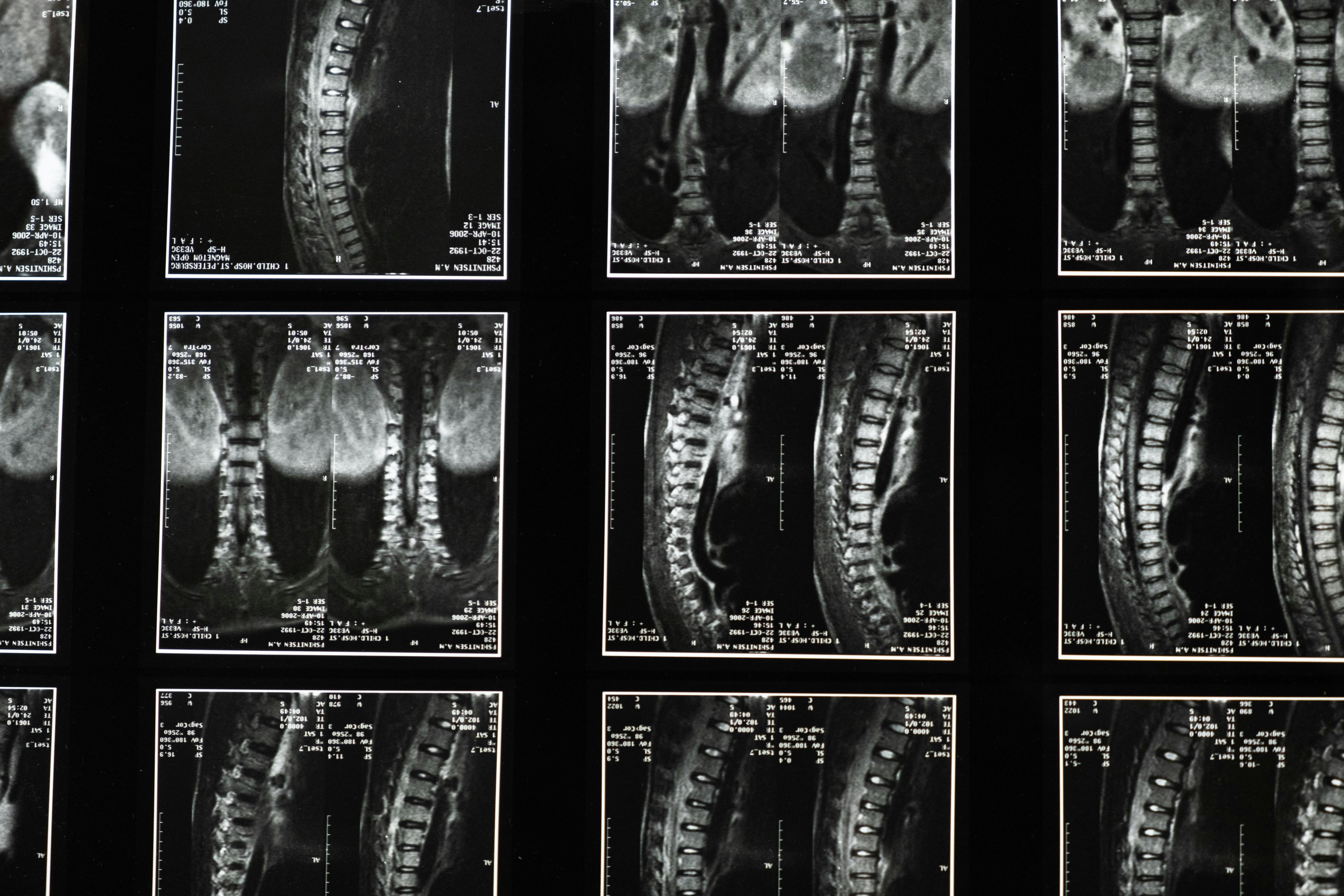 Tethered Cord Syndrome in EDS: 15 Questions Answered by a Leading Neurosurgeon