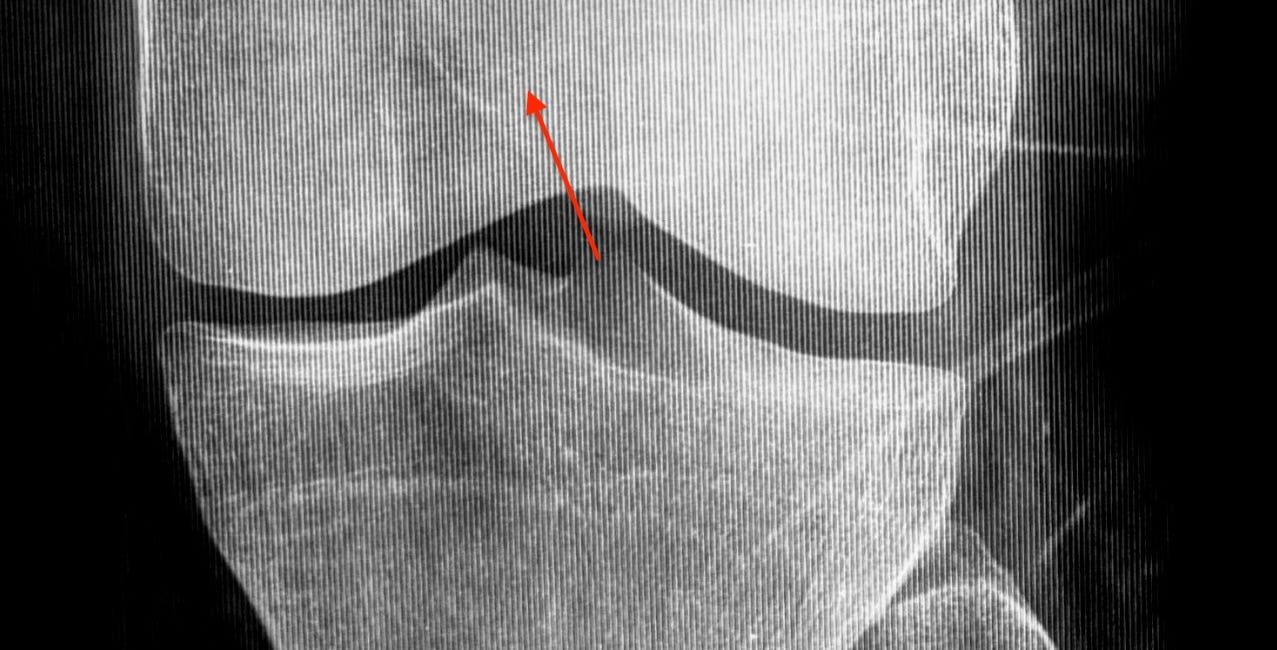 Case 74 - A Distal Femur Lesion